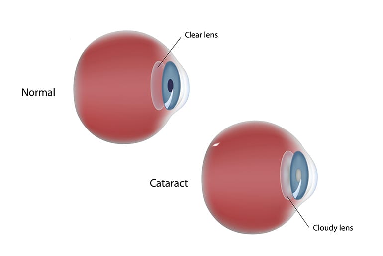 Cataract, Sight Saving Surgery, Miracles Day